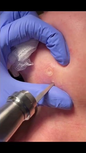 Dermal Nevus removal #shorts