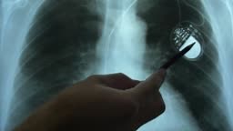 Doctor Examining X-Ray Image of Chest with Artificial Cardiac...