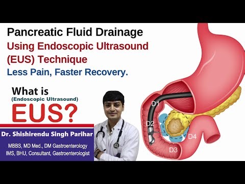 🩺 Pancreatic Fluid Drainage Using Endoscopic Ultrasound (EUS) Technique | Apex Hospital | Varanasi