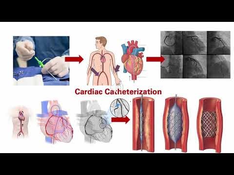 Cardiac Catheterization 3MT slide presentation