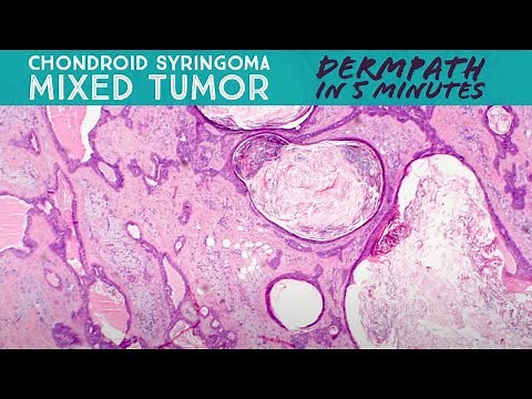 Chondroid syringoma / Mixed tumor: Dermpath in 5 Minutes (dermatology pathology dermatopathology)