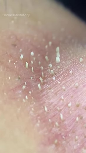 Vejam essa remoção detalhada de cravos. #cravos #cravoseespinhas #espinhas #tirarcravos #pimple