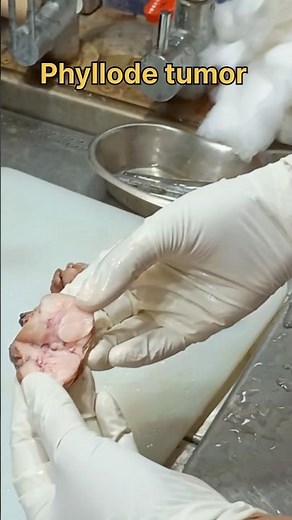 Breast phyllode tumor specimen | #histopath #histopathology #histomuseum #breastgrowth #breastcancer