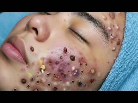Loan Nguyen Acne Extraction - Clear Skin Results