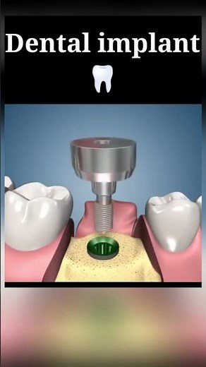 Tooth Replacement with Implant – Step-by-Step