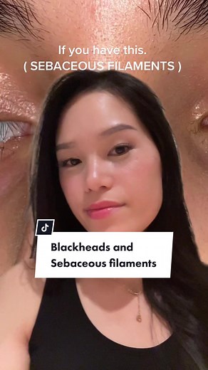Effective Ways to Treat Sebaceous Filaments and Blackheads