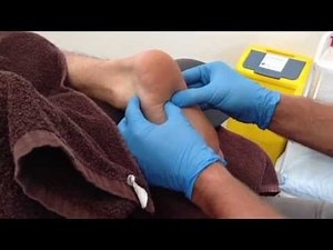 Dry Needling: Quadratus Plantae
