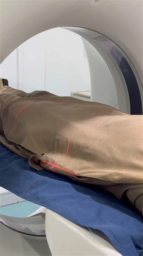 CT KUB Diagnostic Highlights | From Calculi to Hydronephrosis#shorts #viral #popular #highlights#hit