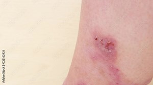 rash, hives, itchy skin on leg, inflammation and Medical Allergies, disease female patient, Dermatology Issues, skin problems on general physical and emotional well-being