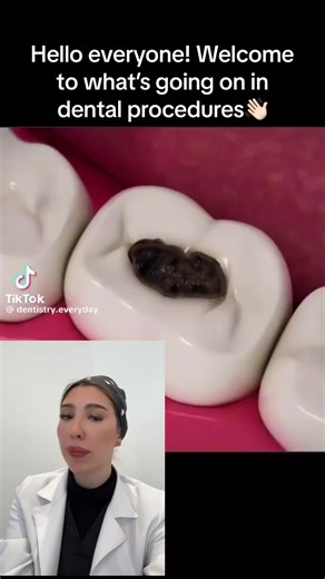 Understanding Indirect Pulp Capping in Operative Dentistry