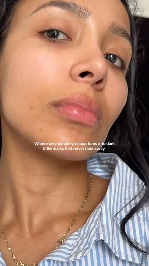 Dr. David Kim on Instagram: "Skincare recommendations for hyperpigmentation from acne scars ✨ Acne is all about prevention so try to stick to this routine even if you don’t have acne so you can treat hyperpigmentation and keep acne under control. 👨🏻‍⚕️ ✅ Benzoyl Peroxide. Use 4% BP wash every day to keep your acne under control. @panoxyl ✅ Azelaic acid 15%. Azelaic acid helps treat acne and hyperpigmentation, and is pregnancy safe! Use this every morning. ✅ Tinted SPF. Use tinted