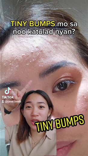 DI MATANGGAL NA PIMPLES O TINY BUMPS SA NOO?? Samed sis! Ganyan din ako 😭😭 Iba ibang skincare na ang natry ko pero wala talagang pag asa 😭 buti nalang natry ko yung BTY Basic Skincare Set 💗 may pag asa pa pala yung mapimple kong face 🥺💗 #acnetreatmenttips #acnejourney #BTYOvernightMask #tinybumps #tinybumpssolution #skincareroutine #acne #pimples #skincaretips #dryskin #clearskin #Ceeebee tanggal pimples tanggal tiny bumps skincare for acne acne journey BTY Overnight Mask
