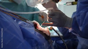 Treatment of a brain aneurysm. Surgical operation on the brain. A team of surgeons performing brain surgery to remove a tumor.