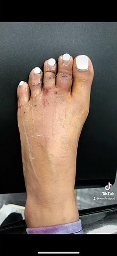Let's Straighten and Shorten Some Toes with Foot First's exclusive Toe Shortening Procedure ✨
