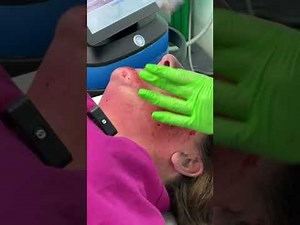 Morpheus 8 Treatment (Full Face)