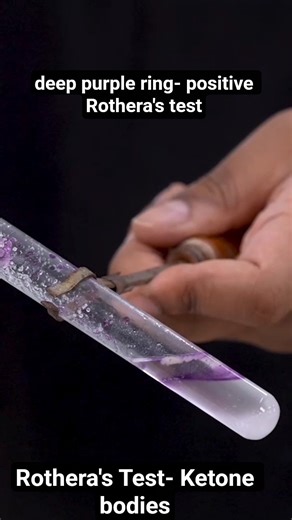 Rothera's test- Ketone bodies, Practical skill videos 3.0 ‪@PWMedEd‬