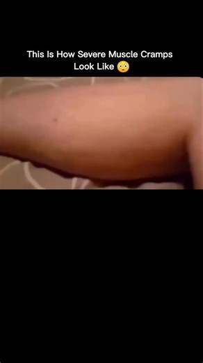 Mysteryreels.io 🇺🇸 on Instagram: "A muscle cramp is a sudden, involuntary squeeze of a muscle that can be sharp and painful. It most often strikes the legs or feet, either during physical activity or in the middle of the night. These cramps occur when tired or stressed muscle fibers react to mixed-up signals from the nerves-something that can happen due to dehydration, low electrolytes, overexertion, or reduced blood flow. When the muscle tightens and refuses to let go, gently stretching or ma