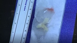 Doctor: Tapeworm removed from man's brain after living inside for over a decade