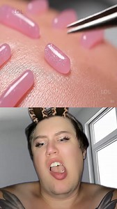 4.8M views · 28K reactions | Relaxing Acne Extraction Process ASMR 1 Part | LOL | Facebook