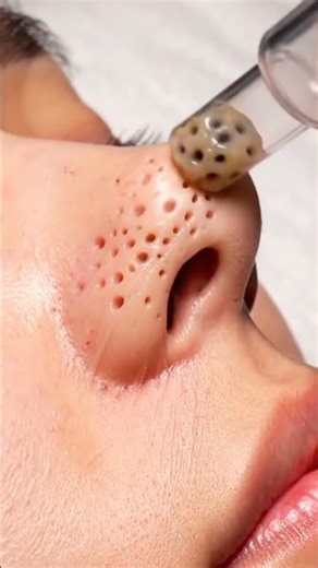 Deep Pore Vacuum Treatment – Crystal Clear Skin Transformation | 4K Skincare ASMR”