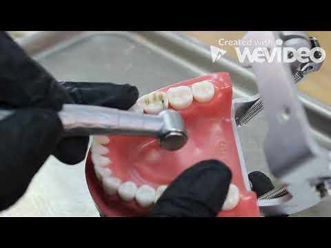 Porcelain fused to metal crown preparation