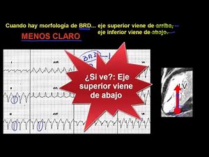 EXTRASÍSTOLES VENTRICULARES