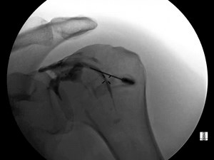 Glenohumeral Joint Injection With Fluoroscopy - The Pain Source