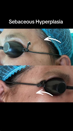 Understanding Sebaceous Hyperplasia and Its Effects