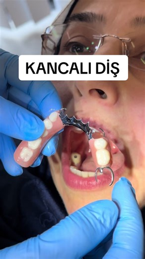 Kancalı Protez ile Gülüş Tasarımı