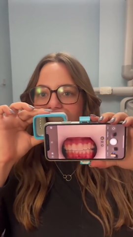 Dentistry Everyday on Instagram: "Sneak peak👀🤭 the new Invisalign lens! This is for enhanced remote treatment monitoring. Allowing Dr. Kamel to watch your treatment more accuracy with less appointments! . . . . 📽By @MYsmile Dental from Ticktok • • --------------------------------------- 📥 Post your case on #dentistry_everyday to get repost --------------------------------------- Like & Follow for the love of dentistry and more such interesting content 💯. • Loved the outcome • Tag a Friend •
