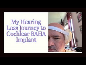 My Hearing Loss Journey to Cochlear BAHA Implant