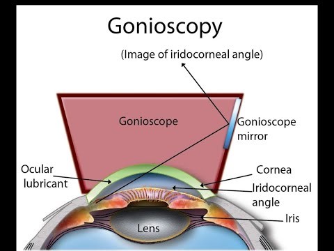 Gonioscopy procedure to evaluate the anterior chamber angle of the eye ; Application, Importance