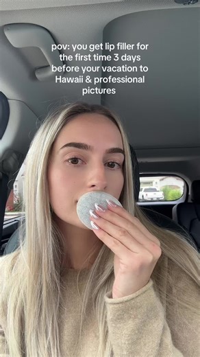 First-Time Lip Filler Experience Before Vacation