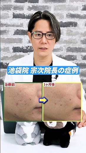This is a case study of the Hanafusa method of acne scar treatment at Hanafusa Dermatology Clinic...
