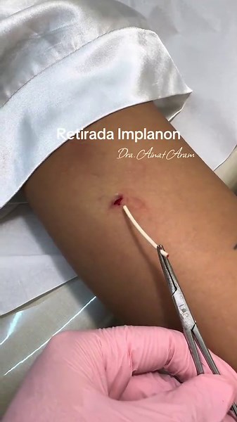 Retirada do Implanon: Cuidados e Informações