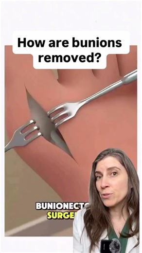 How are bunion surgeries done?