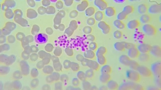 8K views · 123 reactions | EDTA-induced pseudothrombocytopenia occurs...