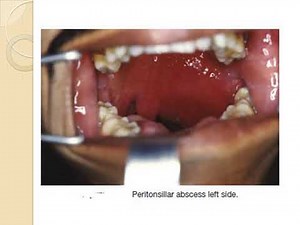 quinsy and parapharyngeal abscess