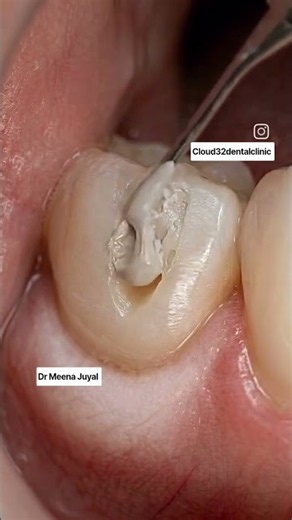How to do dental Filling #toothfillong #dentalfilling