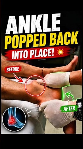 😱 Ankle Popped Back Into Place! | Real Dislocation Reduction Painful Ankle Dislocation #dislocation