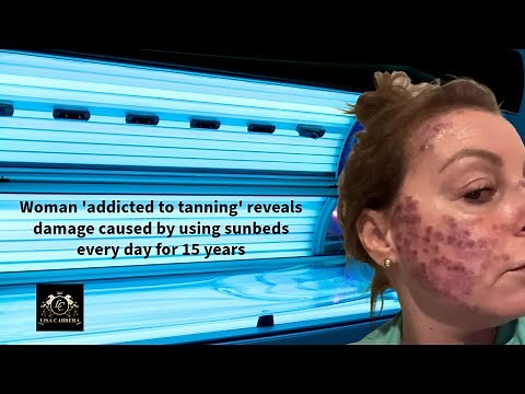 Woman Addicted to Tanning Unveils Sunbed Damage After 15 Years of Daily Use