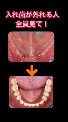 【Amazing Stability】Solve Your Loose Denture Problems with 2 Implants! #Implant #Dentist #OmiyaDen...