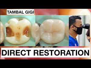 Step by step Filling Composite Lower Molar Direct Restoration Class II | General Dentist Griya RR