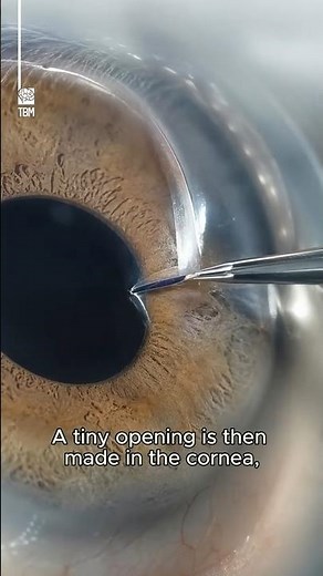 Cataract Surgery Explained