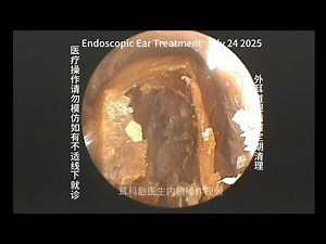 Regular cleaning of cholesteatoma of the external auditory canal 20250724