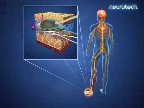 Effects of TENS Therapy 2: Endorphins