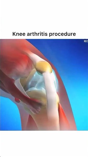 Knee Arthritis #animation #facts #surgery #satisfying #trending #shorts #ai #shorts #arthritis