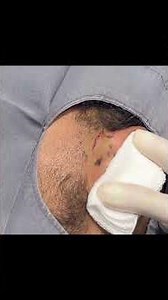 What They Wouldn't Show You About This Ear Cyst