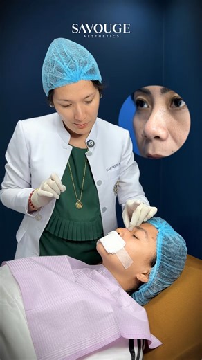 Get a higher, more defined nose bridge in just minutes with our HIKO Nose Thread Lift. ✅ Non-surgical, minimal downtime ✅ Instantly lifts and refines the nose ✅ Natural-looking results that last Perfect for anyone who wants a sharper, more balanced profile — without going under the knife. 📍 Available in all Savouge branches 💳 All major credit cards accepted Book your HIKO Nose Thread Lift today! | Savouge Aesthetics Pampanga