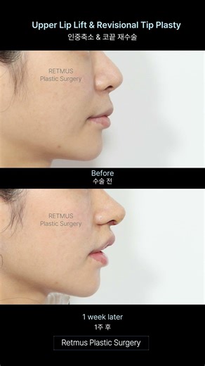 ✅ 인중축소와 코끝 재수술로 완성한 동안의 정석 & 조화로운 비율 ㅣ Upper Lip Lift & Revisional Tip Plasty for a Youthful Face